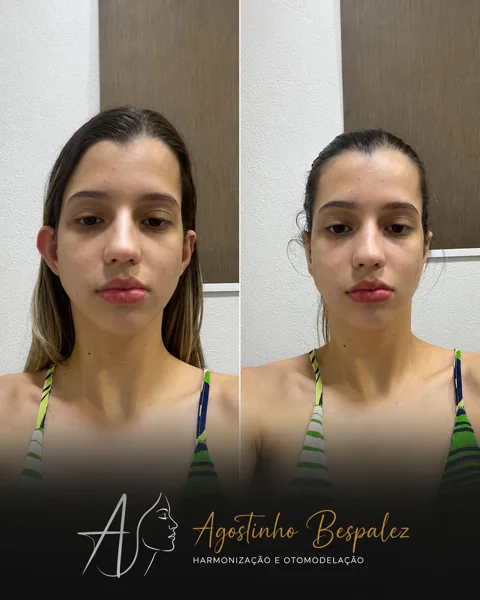 Otomodelação — antes e depois
