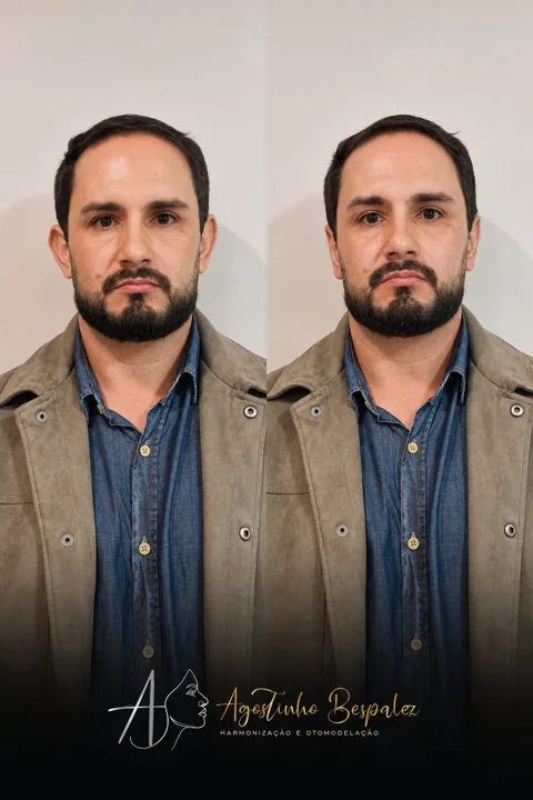 Otomodelação — antes e depois