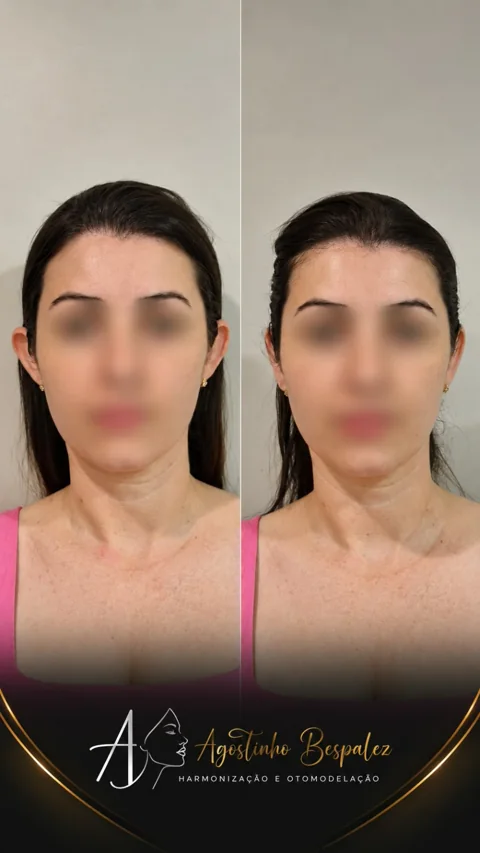 Otomodelação — antes e depois