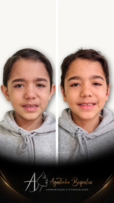 Otomodelação infantil — antes e depois