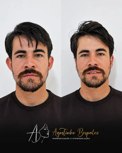 Otomodelação — antes e depois
