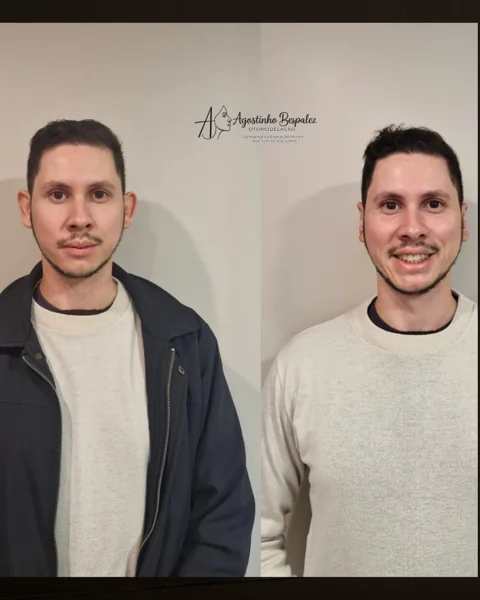Otomodelação — antes e depois