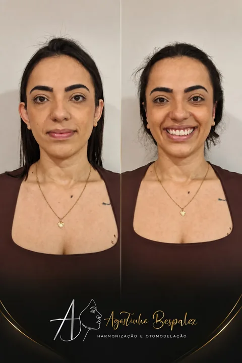 Otomodelação — antes e depois