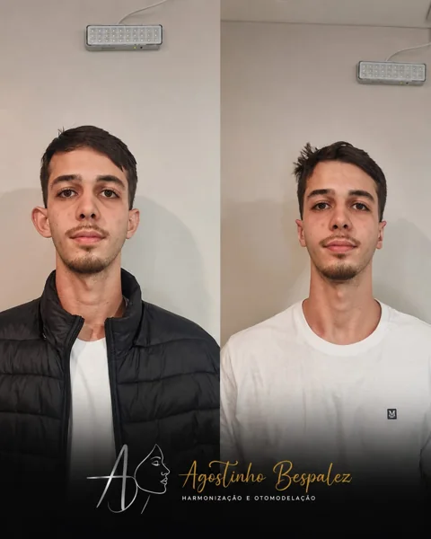 Otomodelação — antes e depois