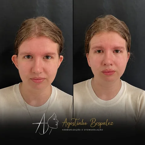 Otomodelação — antes e depois