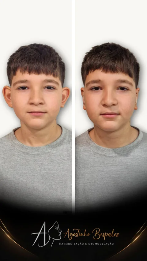 Otomodelação infantil — antes e depois