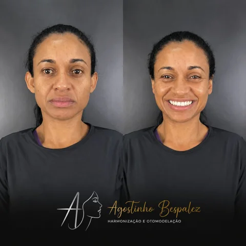 Otomodelação — antes e depois
