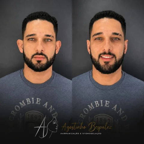 Otomodelação — antes e depois
